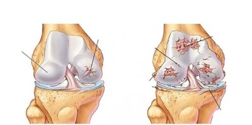 деформираща артроза на коляното