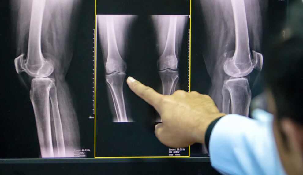 артроза на колянната рентгенова снимка