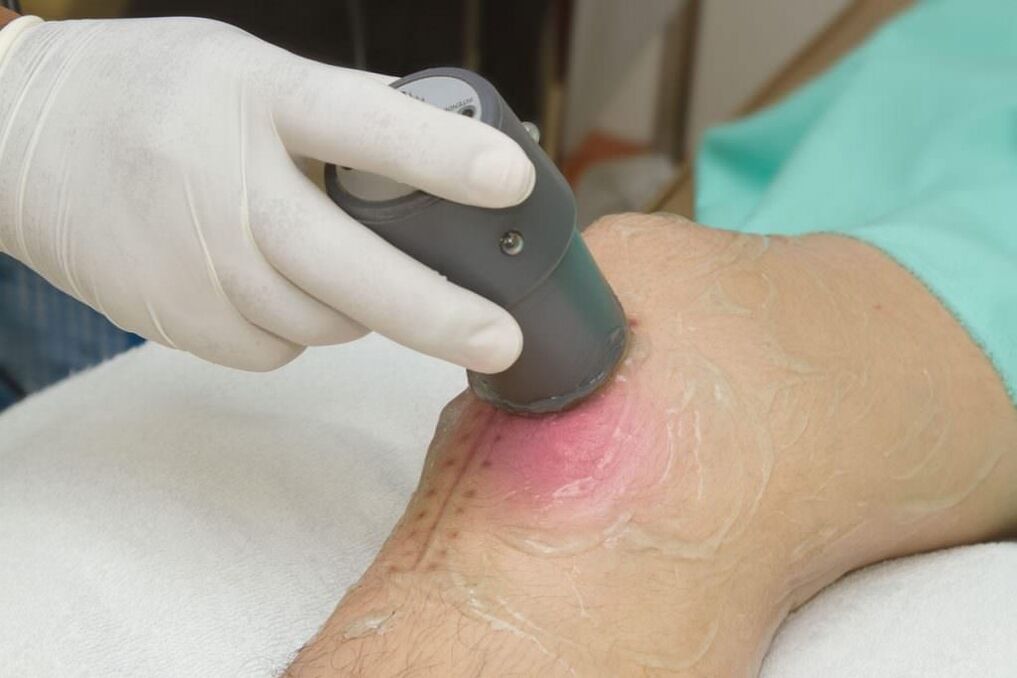 Процедура за фонофореза при артрит на колянната става