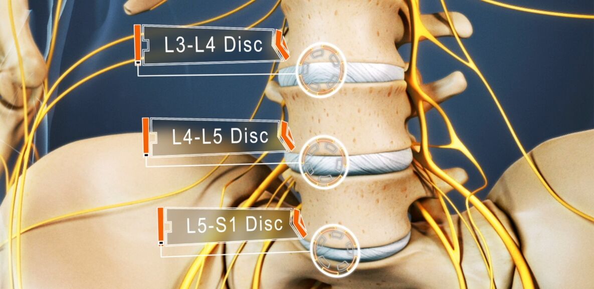Дискове на лумбалния гръбначен стълб, които най-често се засягат при остеохондроза