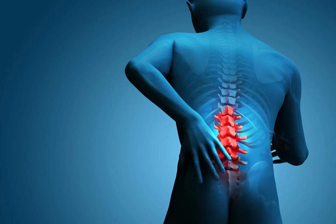 Основният симптом на остеохондроза на лумбалния гръбначен стълб е болката в долната част на гърба. 