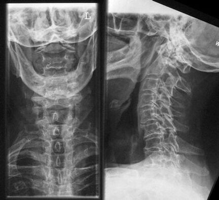 Цервика X -Ray - Метод за диагностициране на остеохондроза