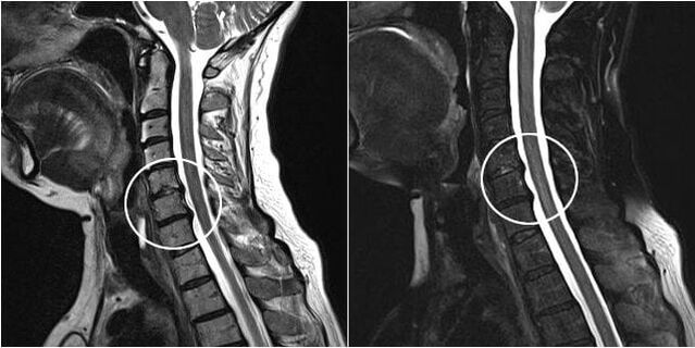 MRI на шийните прешлени